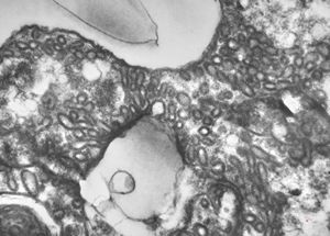 M,3m. | Pneumocystis carinii